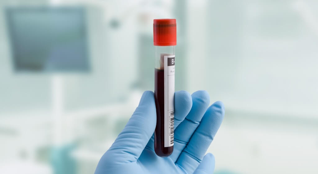 Hand holding vial of blood, representing liquid biopsy samples for cancer research with NGS DNA sequencing and methylation sequencing.